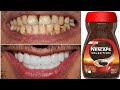 teeth whitening at home in 2 minutes / how to naturally whiten your yellow teeth