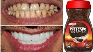 teeth whitening at home in 2 minutes / how to naturally whiten your yellow teeth
