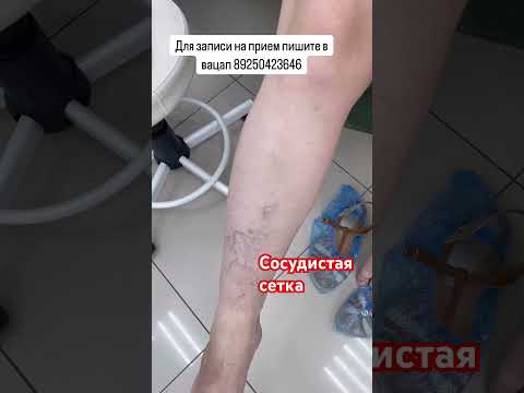 Сосудистая сетка на