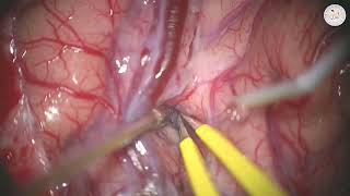 Video 2 MCA aneurysm (Preview)