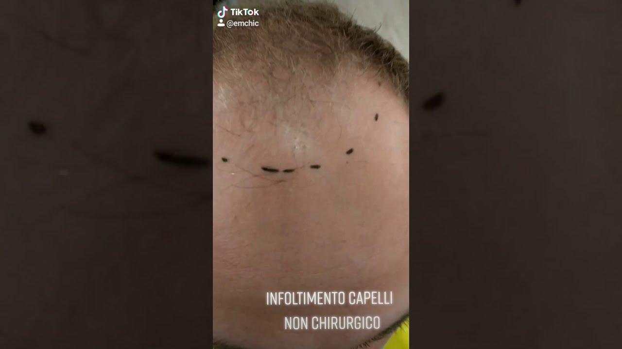 infoltimento capelli non chirurgico