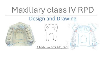 Maxillary Class IV RPD Design: Step-by-Step Guide to Surveying & Drawing on Casts and Paper