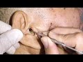 Elderly Man&#39;s Black Earwax Removed Using An Ear Curette