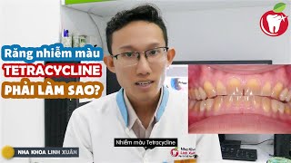 Top 12 cách làm trắng răng nhiễm tetracycline đặc sắc nhất năm 2022