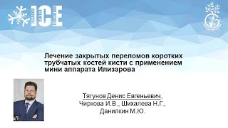 Лечение закрытых переломов коротких трубчатых костей кисти  с применением мини аппарата Илизарова