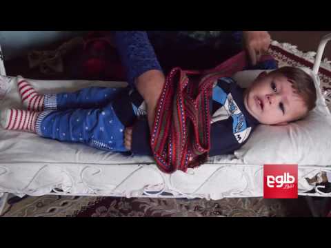 پزشکان بستن نوزاد جلو رشد او را می گیرد