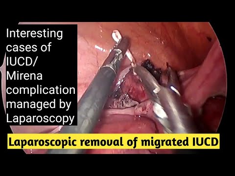 intrauterine contraceptive devices market iud iucd type