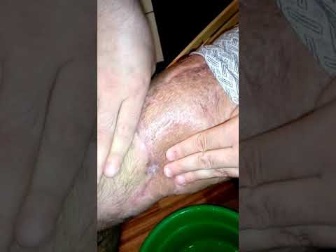 Свищ на ноге лечение в домашних условиях