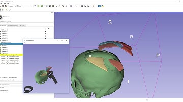 3D Slicer reconstruction of fragmented bones in virtual reality