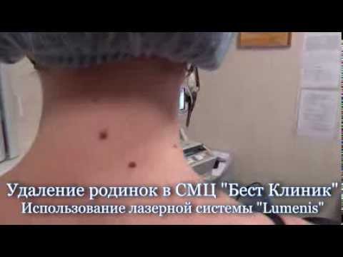 Удаление родинок