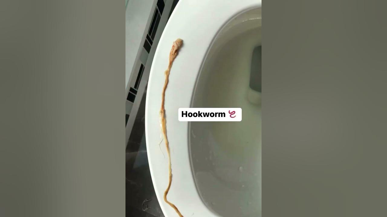 Intestinal Parasites, gallstones, mucoid plaque during live colon