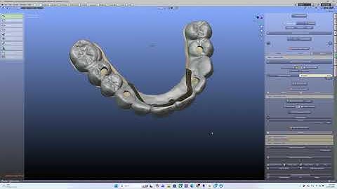B4D Dental ModulesIBar - Editing the cutter for a metal occlusal surface.