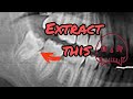 Extract this tooth surgical extraction