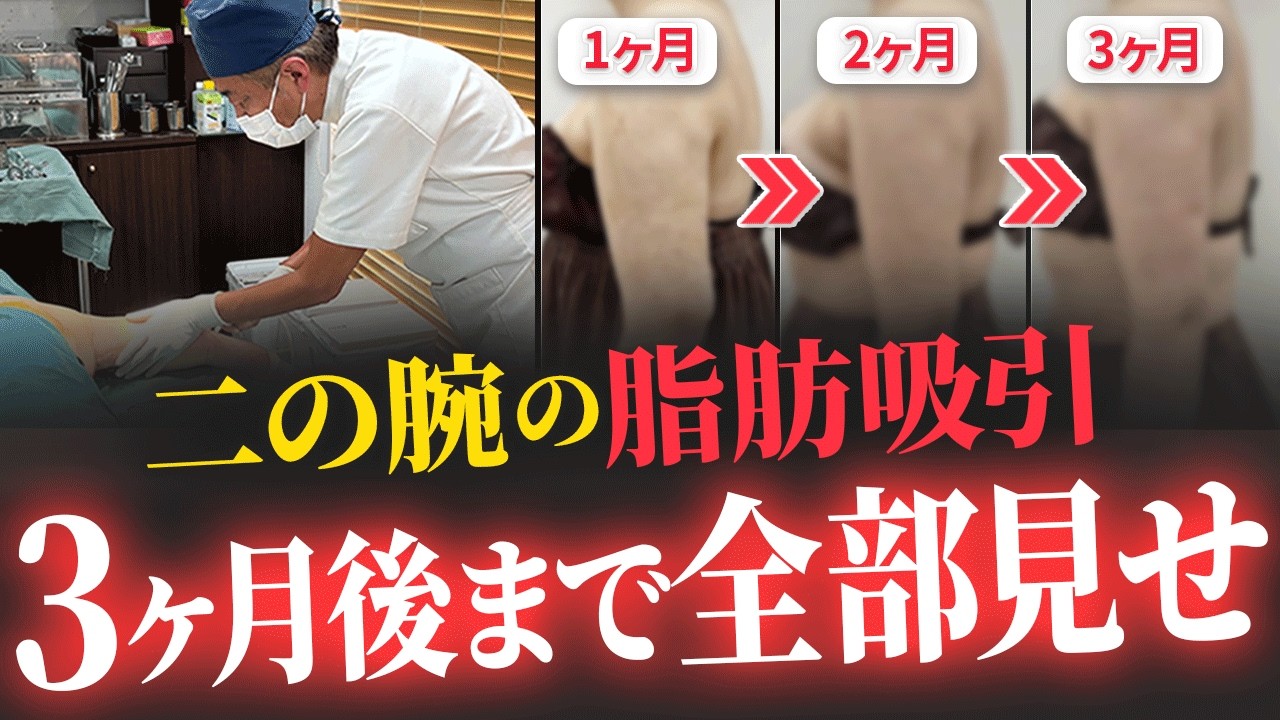 ウォータージェット 脂肪吸引 | アサミ美容外科