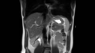 What does the spleen look like on MRI?