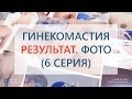 Смешанная гинекомастия.  Результат удаления смешанной гинекомастии 3 типа (6 серия)