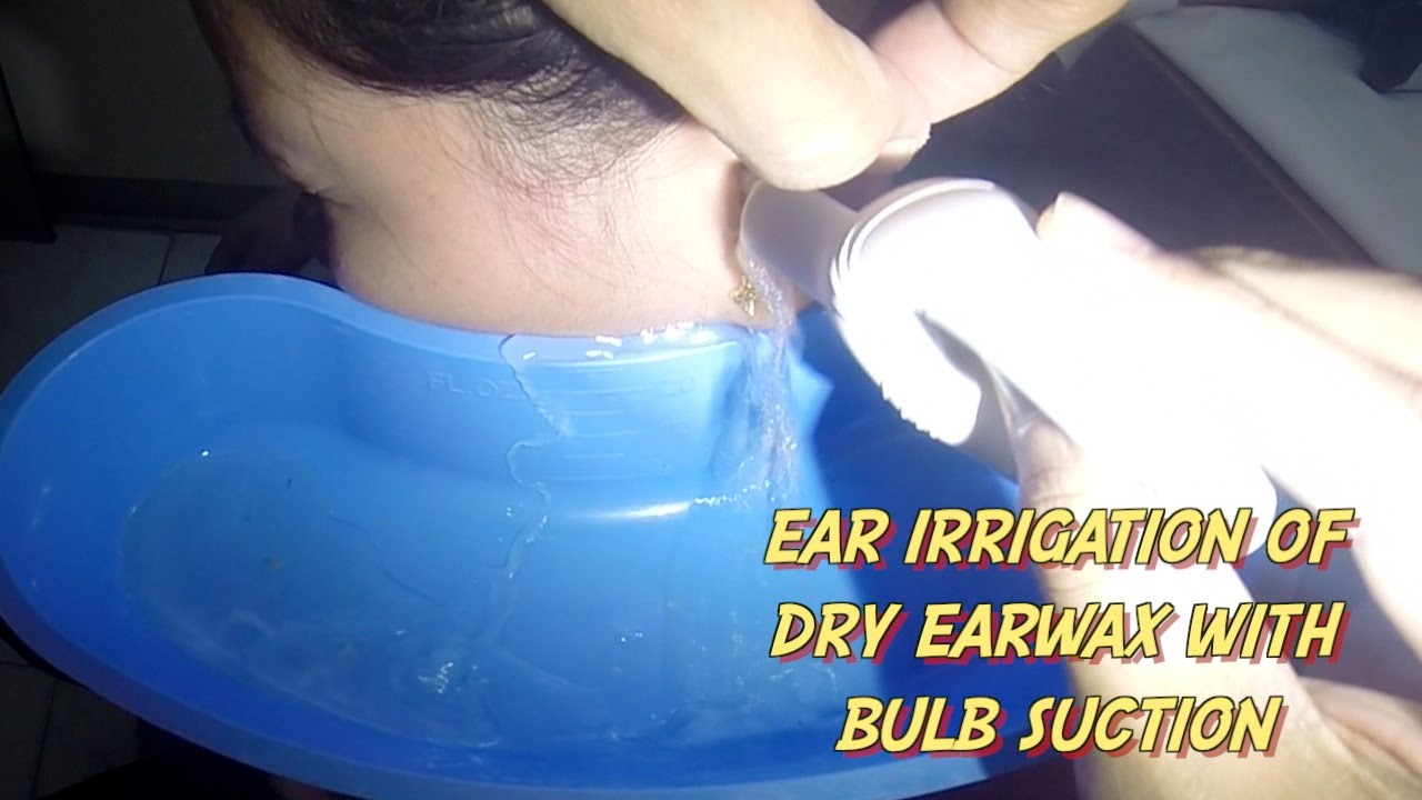 Ear irrigation of Dry Earwax with Bulb Suction YouTube