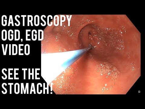 Gastroscopy | OGD | See inside the stomach!