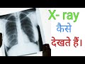 How to read Chest X-ray || Hindi language