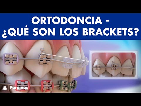 Que funcion tienen los brackets en los dientes