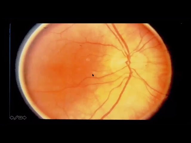 How to improve eye circulation.