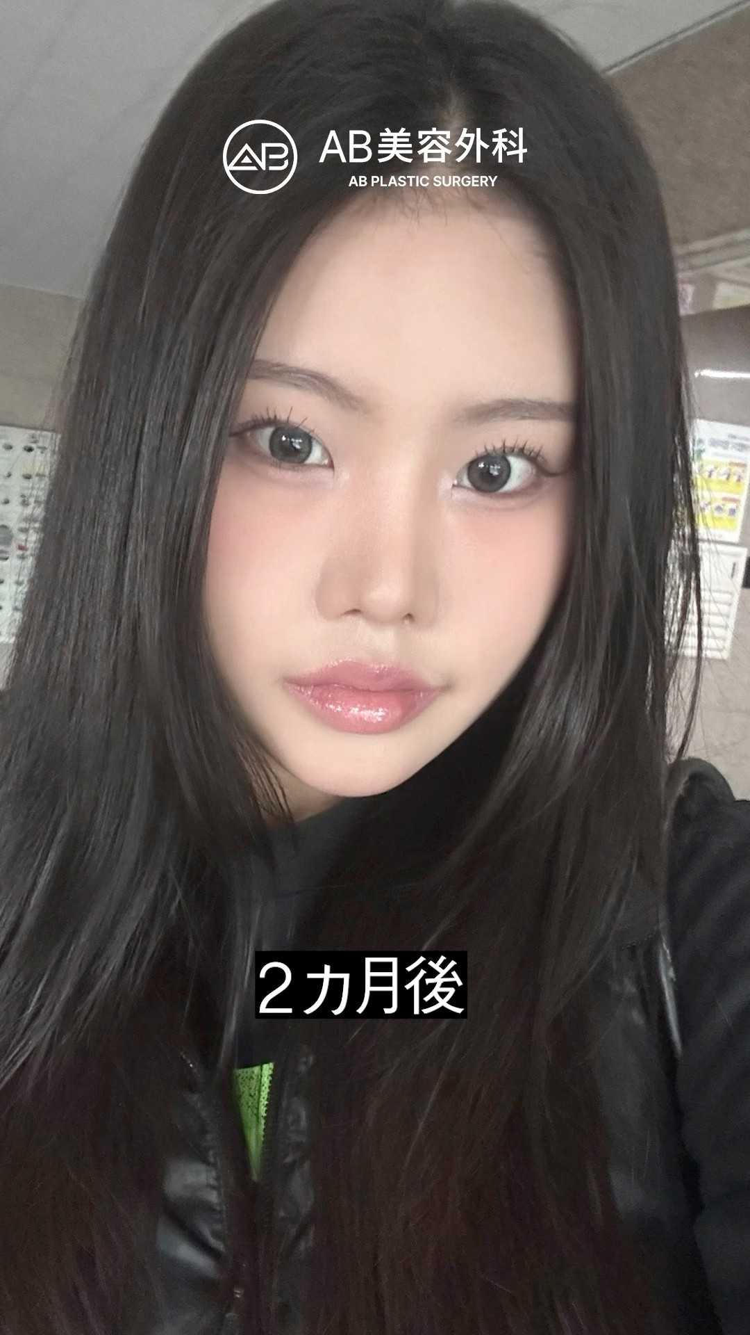 韓国整形で劇的変化！輪郭手術ビフォーアフター | AB美容整形
