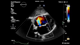 Врожденный порок сердца. ЭХОКГ в Уссурийске.