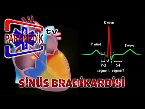 Video: Kalp bradikardisinin nedenleri ve semptomları