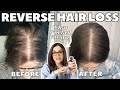 How I STOPPED MY HAIR LOSS! | #1 Thing That Re-Grew My Hair