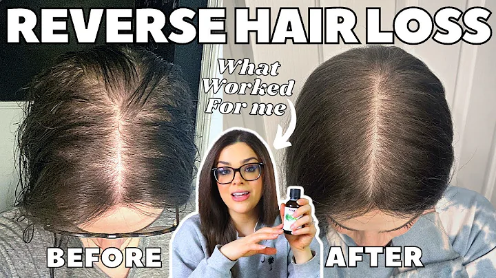 How I STOPPED MY HAIR LOSS! | #1 Thing That Re-Gre...