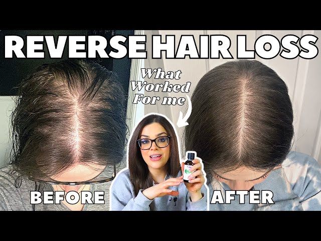 How I STOPPED MY HAIR LOSS! | #1 Thing That Re-Grew My Hair class=