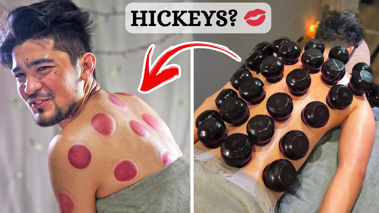 (ASMR) I Experienced HARDCORE Cupping Therapy That Gave Me Intense Hickeys! 😉