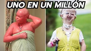 15 Enfermedades Más Raras Del Mundo - INCREÍBLE