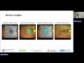 WS3: Navilas® - Evaluating Photodynamic Therapy vs. Subthreshold Microsecond Pulse Laser for CSCR
