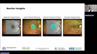 WS3: Navilas® - Evaluating Photodynamic Therapy vs. Subthreshold Microsecond Pulse Laser for CSCR