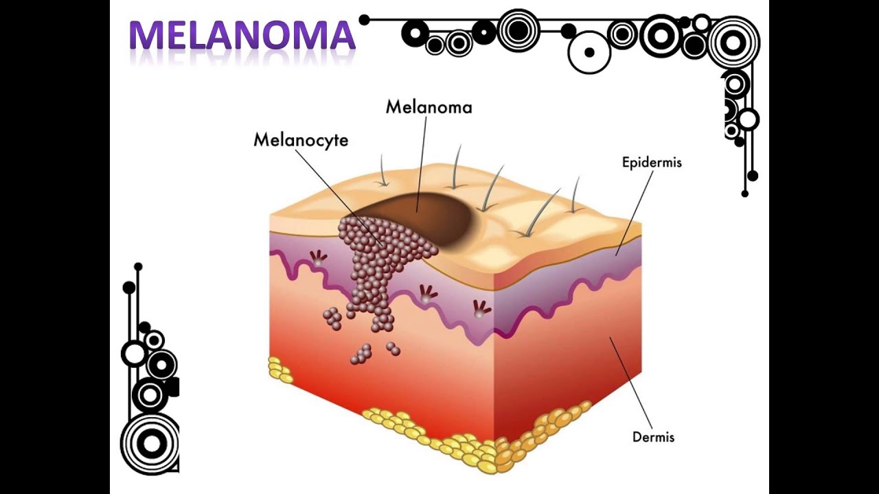 Skin Cancer Body Map