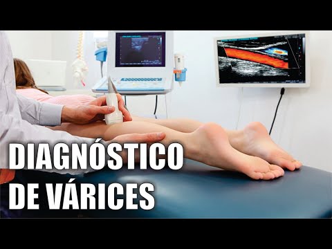 Video: Diagnóstico de venas varicosas