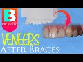 Dental Veneers after Braces or Invisalign