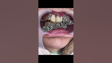 Thumbnail of ⚠️超閲覧注意⚠️大量歯石の画像です⚠️