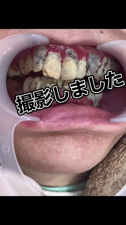 ⚠️超閲覧注意⚠️大量歯石の画像です⚠️