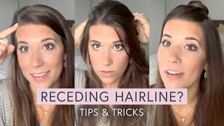 RECEDING HAIRLINE? tips + tricks!