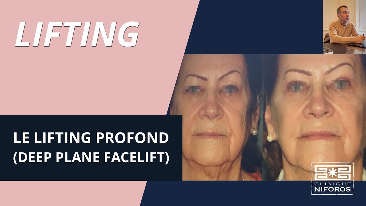 Lifting profond ou deep lane facelift - Dr Niforos chirurgien plasticien à Lyon