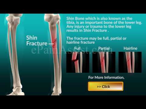 What Is Shin Fracture/Tibia Fracture?