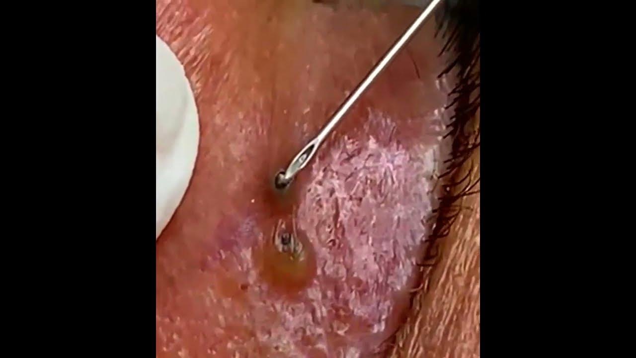 blackhead acne removal video, Satisfying every day with Loan Nguyen Spa