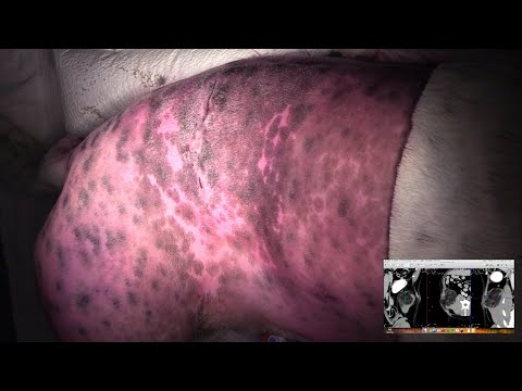Video: Lipoma (kožne Grudice): Vzroki, Diagnoza In Zdravljenje