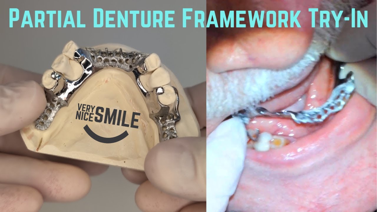 partial-denture-with-metal-framework-try-in-youtube