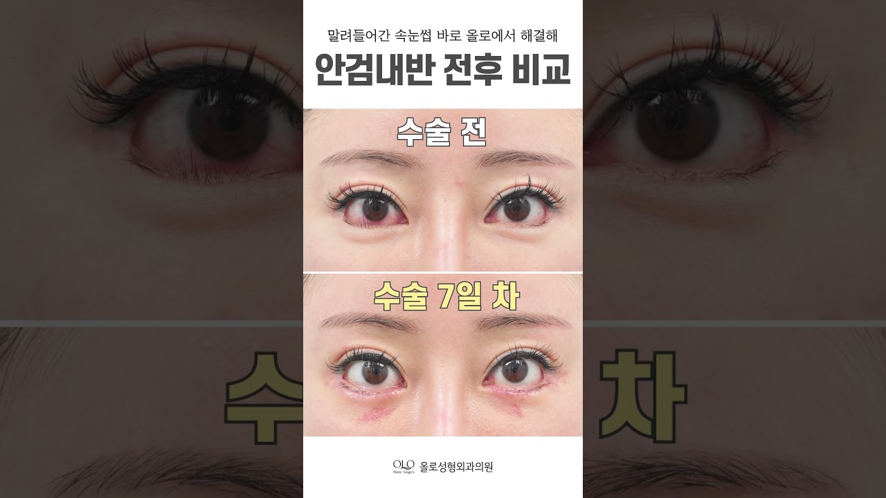 [OLLO整形外科診所] 倒睫毛 立即 #OLLO整形外科 #解決 #rightnow #現在這裡 立刻！ 在OLLO解決！ #short