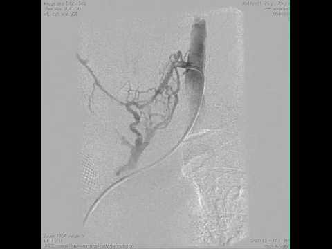 venous hypertension and thyroid