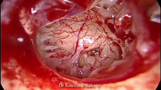 Endoscopic Stapedotomy 