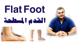 علاج الفلات فوت او القدم المسطحة | Flat Foot